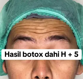 #fypシ゚viral #fyppppppppppppppppppppppp #botox 