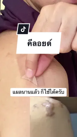 #แผ่นซิลิโคนลดรอยแผลเป็น #แผลผ่าตัด #แผลคีลอยด์ #เจลลดรอย #CapCut 