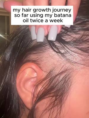 Oh my God! My hair has improved due to using this Tgideas Batana Scalp Oil