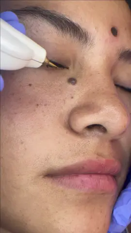 📍Trujillo 🇵🇪 CAUTERIZACION DE LUNAR #tratamientosfaciales #trujilloperu🇵🇪 #lunares #verrugas #cauterizaciondeverrugas 