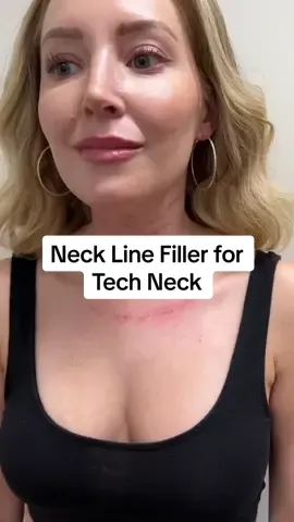 #onthisday repost of neck filler before and after for you all 🫶🏻 #necklinefiller #filler #fyp