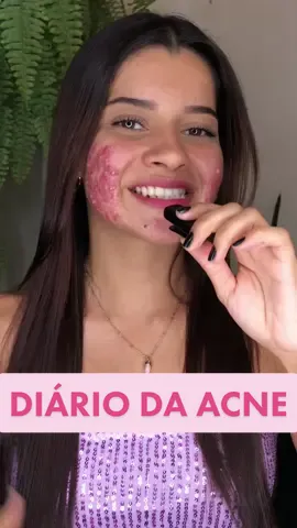 Diário da acne - ep 1  Esse video é de maio, tivemos algumas mudanças ate aqui, jaja solto a parte dois! No app vizinho vocês conseguem acompanhar em tempo real ✨ #acne #roacutan #skincare 