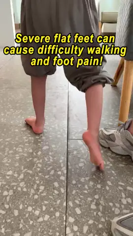 Severe flat foot: difficulty walking and foot pain#flatfoot #valgusfoot #varusfoot #Olegs #Xlegs #Archsupport 