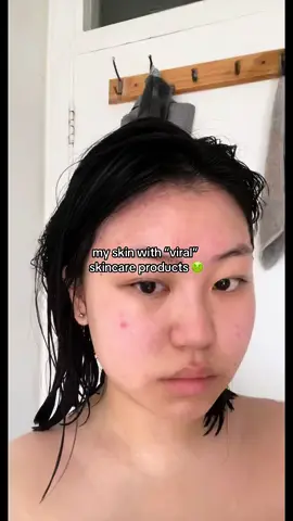 @Eqqualberry eqqualberry swimming toner is such an underrated exfoliating toner for sensitive skin omg… just bc a product is viral doesn’t mean it’ll work for you!! - i have sensitive combination skin and i have had breakouts from using viral products just bc i’ve seen the brand all over tiktok… some products are viral bc they genuinely are amazing! but it doesn’t mean it’s suited for everyone. e.g. bha/aha (salicylic acid) is recommended for exfoliating skin and targeting blackheads/sebum… but if u have sensitive skin then it can be really irritating. eqqualberry toner is a good alternative for sensitive skin! snail mucin is also another example of a viral product that might not work if u have a dust mite allergy… there are vegan options that tackle this tho! - #fyp #beforeandafter #naturalskincare #sensitiveskin #eqqualberry #naturalskincare #skincare #koreanskincare #deinfluencing 