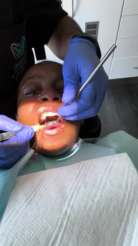 Nerve removal #fypシ 
