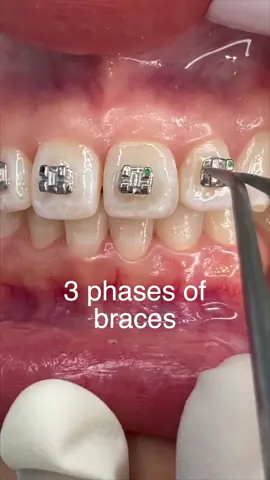 3 phases of the braces. On average, full braces cases typically last around 18-24 months, and these 3 phases are distributed evenly over that time. Every case and patient is different though, so be sure to keep clear communication open with your orthodontist to understand how your case is progressing.  Thanks to @Dr. Enrique Cruz and @OrthoStyle for letting me use some of your video clips to help others. #braces #retainer #orthodontist #braceface #dentist #bracesoff #dentalassistant #hygienist 