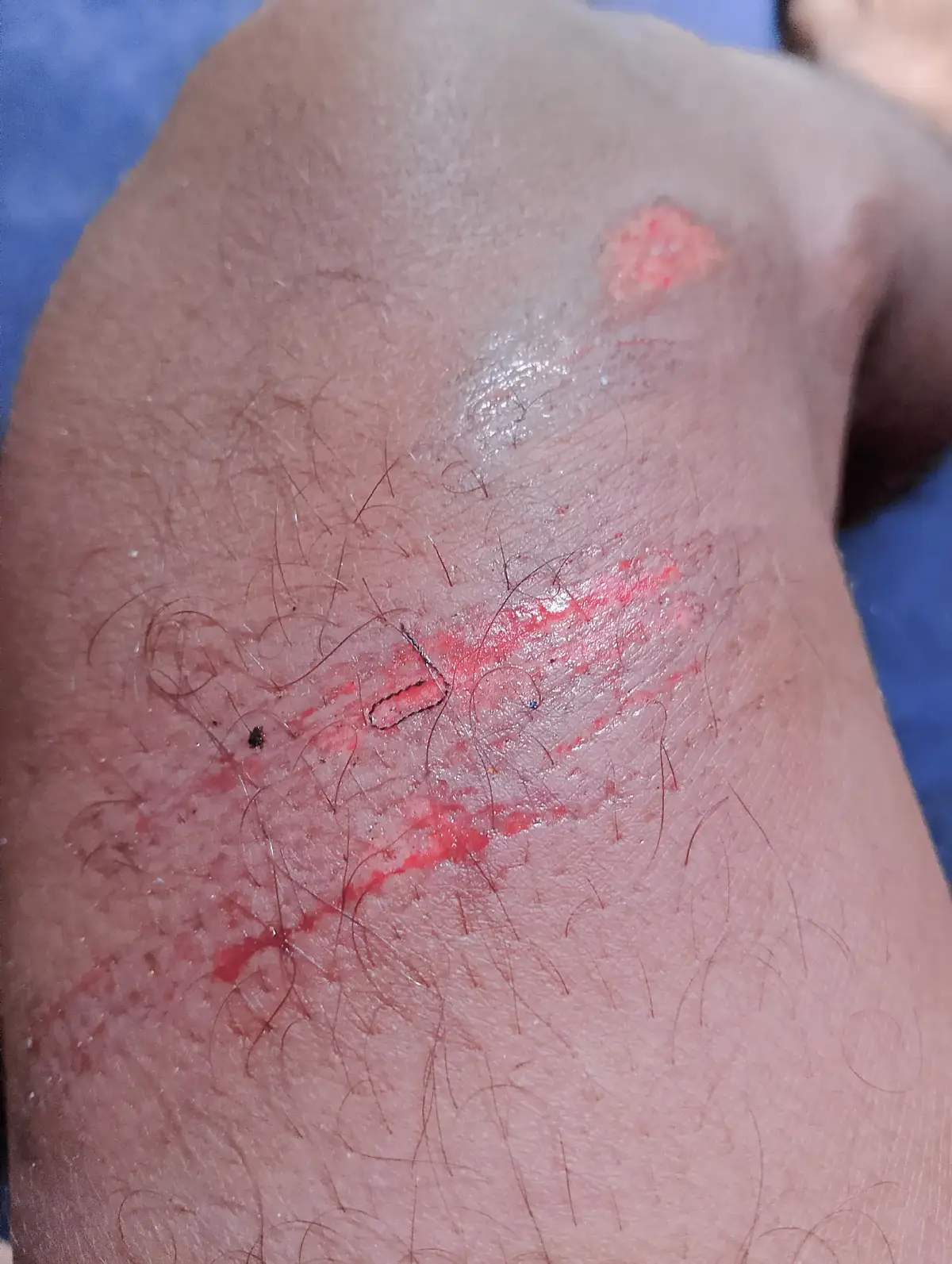bike accident😭🥺😰###tiktokemotion😭 #tiktokviber😆😍🤗 #tiktokvlog #tiktokpost 