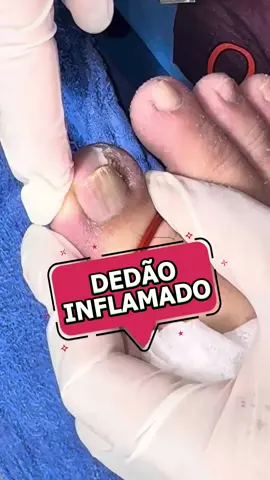 Dedão bem inflamado.. #ingrowntoenailremoval #ingrowntoenail #uñaencarnada #unhasencravadas #unhaencravada 