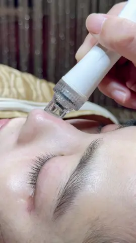 Aqua Peeling ASMR - thư giãn detox làn da, làm sạch mụn đầu đen . Dọn sạch lỗ chân lông sau 60 phút #aquapeel #Kassyspa #thammycantho #spacantho #cantho #relax 