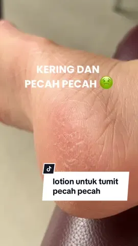 penyelamat tumit pecah pecah 🥹🫶🏻 ga expect beneran works secepet itu‼️ #penghalustumit #tumitpecahpecah #obatkakikapalan #footcare #prepare_id @Prepare 