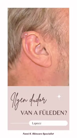 💁🏻Ez bizony BAZALIOMA. A basalioma (carcinoma basocellulare) Magyarországon a leggyakoribb rosszindulatú (malignus) bőrdaganat. 🔹Egy olyan daganat, ami a bőr azon részein nő, amik sok napfénynek vannak kitéve.  🔹Természetes, hogy aggódsz, amikor az orvos azt mondja, hogy ez a betegséged van, de nem kell aggódnod, mert ez a bőrrák legkevésbé kockázatos típusa. 🔥Ha korán diagnosztizálják, akkor gyógyítható a betegség . 🔹A daganatok kis fényes dudorokként kezdődnek, általában az orron, füleken vagy az arc más részein. De a test bármely részén megtalálhatók, beleértve a törzset, a lábakat és a karokat. 👉🏻Ez a daganat nem valószínű, hogy a bőrödről átterjed a tested más részeire, de a közeli csontokra vagy más bőr alatti szövetekre átkerülhet. 👉🏻A bazálissejtes karcinóma általában nagyon lassan növekszik, és gyakran évekig nem jelenik meg intenzív vagy hosszú távú napozás után. Fiatalabb korban is kialakulhat ha sok napsütésnek vagy kitéve, vagy szolizol. Világos bőrűeknél nagyobb a valószínűsége a kialakulásnak. 💁🏻Kezelésére igen sokféle mód létezik. A leghatásosabb még napjainkban is a sebészi kimetszés. 🔥 Viszont a legfontosabb a megelőzés, ezért használj ☀️FÉNYVÉDŐT☀️ (naptejet) és ne szoliztasd agyon a tested!🥰😎 #skincare #skincareroutine #skincaretips #SkinCare101 #dermatologist #dermatology #dermatologia #cancer #skincancer #skincancerawareness #cancersucks #cancerfighter 