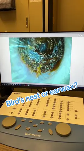 Bird’s nest or earwax?