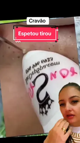 Espetou tirou #cravos #reagindo #terapia #satisfatório 
