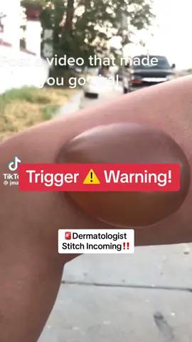 #stitch @JMunguia hope you healed up okay! PSA: never unroof a blister! #skinblister #blister #drsugaiskincare #burncare #woundcare #blisterinthesun #blisterpoppin 