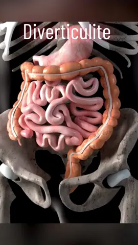 A diverticulite é uma inflamação ou infecção dos divertículos, que são pequenas bolsas que podem se formar nas paredes do trato digestivo, especialmente no cólon. Essas bolsas são comuns e geralmente inofensivas, mas quando se inflamam ou infectam, podem causar sintomas significativos. ### Causas A diverticulite ocorre quando os divertículos se rompem ou ficam bloqueados, levando a infecção e inflamação. Fatores que podem aumentar o risco incluem: - Dieta pobre em fibras - Envelhecimento - Obesidade - Sedentarismo - Uso de certos medicamentos, como anti-inflamatórios não esteroides (AINEs) e esteroides. ### Sintomas Os sintomas da diverticulite podem variar de leves a graves e incluem: - Dor abdominal, geralmente no lado inferior esquerdo - Febre - Náuseas e vômitos - Alterações nos hábitos intestinais, como diarreia ou constipação - Inchaço e sensibilidade abdominal ### Diagnóstico O diagnóstico é feito através de: - Exame físico - Análise de sangue e urina para detectar sinais de infecção - Exames de imagem, como tomografia computadorizada (TC), para confirmar a presença de inflamação e descartar outras condições. ### Tratamento O tratamento depende da gravidade da condição: - **Casos leves**: Podem ser tratados com antibióticos, uma dieta líquida ou de baixo resíduo e repouso. - **Casos graves**: Podem necessitar de hospitalização, onde o paciente pode receber antibióticos intravenosos, fluidos e, em casos severos, cirurgia para remover a parte afetada do cólon. ### Prevenção Medidas para prevenir a diverticulite incluem: - Consumir uma dieta rica em fibras, com muitas frutas, vegetais e grãos integrais - Manter-se hidratado - Praticar exercícios regularmente - Evitar o uso excessivo de medicamentos que podem irritar o trato gastrointestinal. Com essas práticas, é possível reduzir o risco de desenvolver diverticulite e melhorar a saúde digestiva em geral. #diverticulitis #diverticulite #fisioterapia #anatomia #diverticulosis 