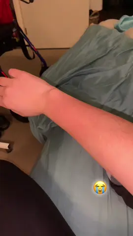 POV you itch your arm so much is bleeding and is all inflamed 😭😭