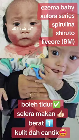 ezema teruk sejak 1 bulan, baby Malik sekarang dah makin cantik kulitnya, bonus dah start suka makan dan berat badan tambah👍🏻👍🏻👍🏻 tips kod ibubapa baby ezema kena ada circle yg positif dan yakin kpd produk. #ezema #baby #imun #auloramelaka #rawatanalternatif #fir #shiruto #spirulina #livcore #BEinternational #DrYuDrPhd 