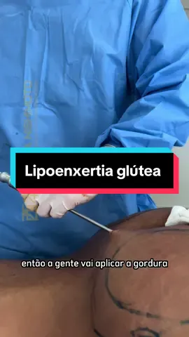 Esse procedimento, tem como objetivo remodelar os glúteos, através da lipoaspiração, a gordura é coletada e após o preparo a enxertia glútea é realizada, promovendo glúteos mais volumosos e harmônicos.  Importante: O resultado acima é individual e não pode ser reproduzido em qualquer paciente. O procedimento é de caráter personalíssimo e a imagem deve ser usada apenas como referência. O vídeo foi devidamente autorizado pelo paciente e sua publicação conforme orientado pela resolução 2.336/2023 do CFM. Clínica Nishimoto - Descubra o Poder da Exclusividade ✨Atendimento que prioriza o conforto: Menu exclusivo com lanches, chás e cafés; ✨Fácil acesso com estacionamento;  ✨Enfermagem 24h; ✨Diversas Especialidades; ✨Equipe médica renomada; ✨Duas unidades para melhor atender. ➡️Unidade Belo Horizonte Hospital Life Center Av: do contorno, N° 4747, sala 713 Funcionários, BH - MG (31) 3889-1016 | 3024-3089 (31) 99221-1364 ➡️Unidade Betim Monte Carmo Shopping Av. Juiz Marco Túlio Isaac, 1119 Loja 1116 - Ingá Alto, Betim - MG (31) 3160-3376 (31) 99559-6040 #lipoenxertia #enxertia #gluteos #cirurgiaplastica 