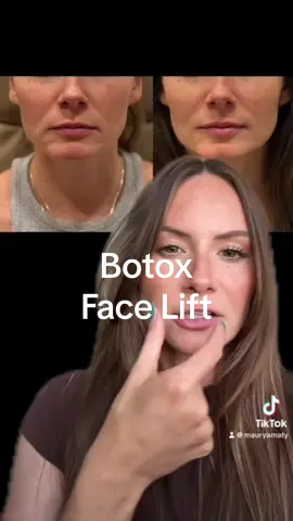 Turned 33 and my genetic were like-hey nice to meet you! #botox #antiaging #injectables #asthetics #facelift #liftface 