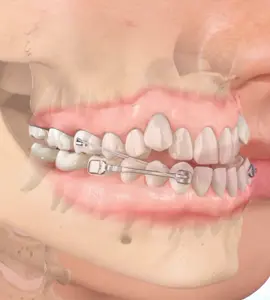 🦷 ¿Cansado de tratamientos largos? Con Carriere® Motion 3D™, ¡dientes alineados en solo 4-6 meses! 🚀 Únete a nuestra master class el 1 de octubre y descubre cómo. ¡Formulariol! 👉🏼https://forms.gle/BSS5FLJA9V6Q5rHZA o en nuestro perfil.  #OrtodonciaAvanzada #ortodoncia #Odontech #maloclusion 