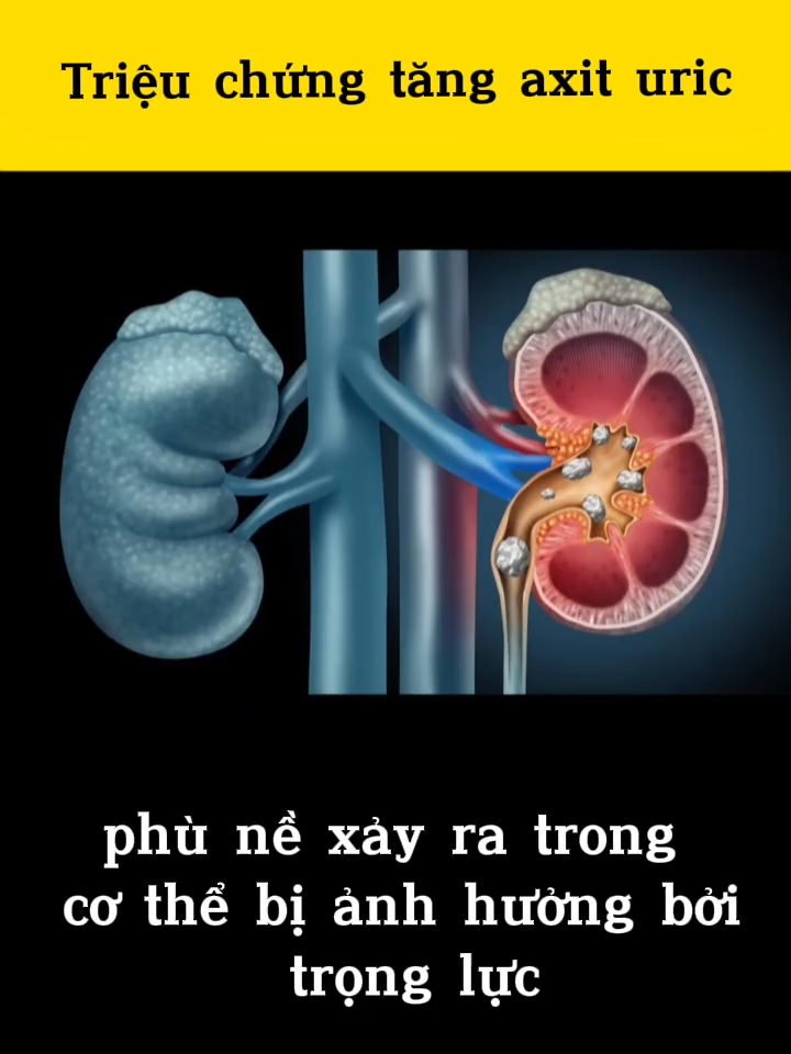 Hãy thận trọng khi axit uric tăng cao #gout #axituriccao #benhgout #goutto #xuhuong #xuhuongtiktok