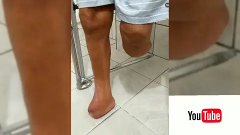 Amputou o pé direito, depois a perna esquerda, tava na cadeira de rodas, saiu andando - DIABETES
