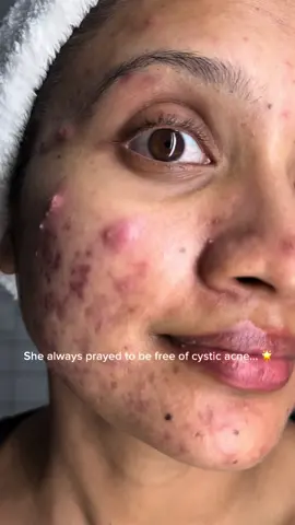 There was a time when all I wanted was to be free of painful cystic acne. It’s incredible to see how far I’ve come. While acne might always return, for now, I'm enjoying this moment. ✨🌟😊💖   #acneproneskin #acneskin #acnetreatment #acnefighter #acnepositivity #acneawareness #acnejourney #cysticacne #acneskincare #cyst #acneprone 