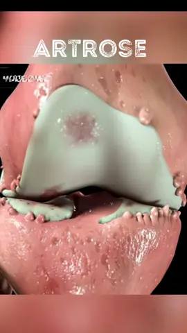 A artrose de joelho, ou osteoartrite de joelho, é uma doença degenerativa que causa desgaste da cartilagem, levando a dor, rigidez e perda de função. É mais comum em idosos e pode ser agravada por obesidade, lesões anteriores e predisposição genética.  ### Sintomas principais: - Dor ao movimentar o joelho - Rigidez, especialmente após repouso - Inchaço e sensação de crepitação - Perda de flexibilidade ### Tratamento: - **Conservador**: Medicamentos, fisioterapia, perda de peso e exercícios de baixo impacto - **Intervencionista**: Injeções intra-articulares de corticosteroides ou ácido hialurônico - **Cirúrgico**: Osteotomia ou artroplastia total/parcial do joelho ### Prevenção: - Manutenção de peso saudável - Exercícios regulares para fortalecer músculos e melhorar a flexibilidade - Evitar lesões usando equipamentos adequados e técnicas corretas O manejo adequado pode aliviar os sintomas e melhorar a qualidade de vida dos pacientes com artrose de joelho.