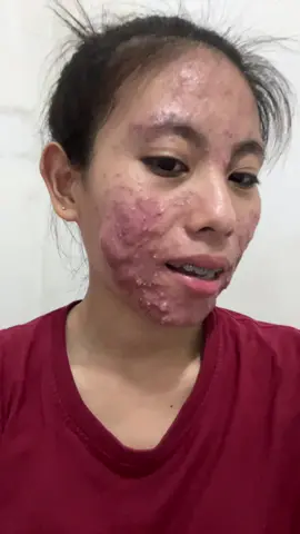 มีสิวไม่มีผลต่อการใช้ชีวิต😘 #ซีแค๊ด #หน้าติดสาร 