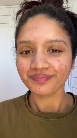 Pimple patch peel off✌️  #pimplepatch #pimplepatchremoval #pimplepatches #pimplepatchpeel #acne #acneproneskin #acnetreatment #acnefighter #acnepositivity #acnefighter 