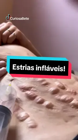 Um tratamento de estrias bem peculiar! imagens: @sarahmarinsb