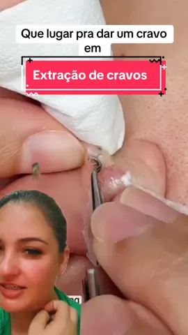 Extração de cravos atras da orelha #cravos #reagindo #terapia #limpezasatisfatoria  