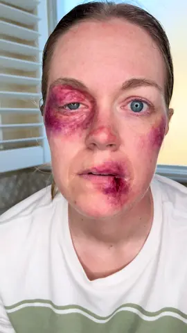 Here’s a boxer makeup look I created yesterday for a film 🥊🎨🎬 I made puffy eye prosthetics, bruises, bloody nose and busted lip!! Such a fun look to do and I went all out with it!!! I added fake sweat as well.❤️ #art #artist #artistsoftiktok #artistsontiktok #arttok #makeup #mua #makeupartist #sfxmakeup #boxer #boxing #fakeblood #blood #bruises #fakebruises #puffyeye #prosthetics #bustedlip #wounds #fakewounds #sfxmakeupartist #film #filmmaking #fyp #fypシ゚viral #fypシ゚ #foryou #foryoupage #skinillustrator #details #dfw #dallas #dallasartist #makeuptok #sneakpeek #actor #acting #director #filming 