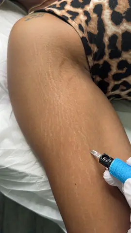 #stretchmarkremoval #stretchmarksremedy #stretchmark #stretchmarks 