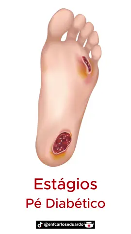 Estágios do pé diabético #enfermagem #tecnicodeenfermagem #tecnicoemenfermagem 
