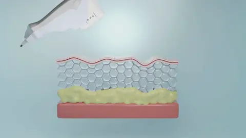 #harmonização #harmonizacaofacial #hifu #ultrassommicrofocado 