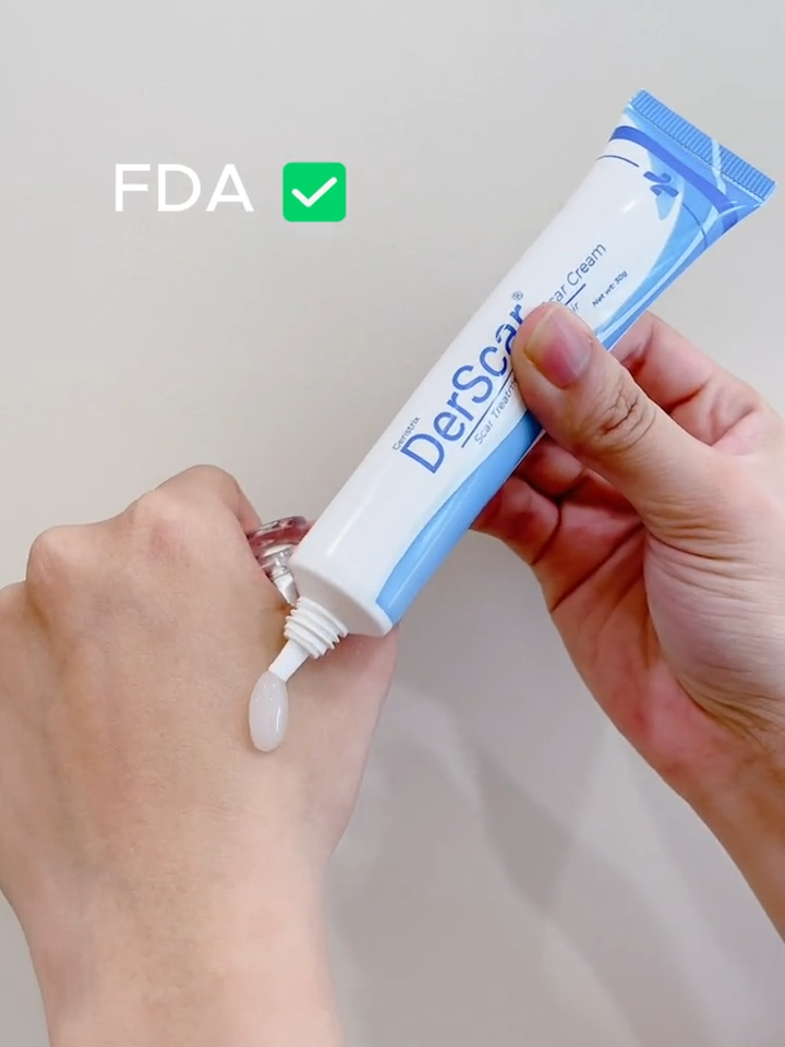 OMG, The 5 year scar has faded a lot. The product is safe and benign, so use it with peace of mind 💓 #derscar #scarcream #peklatcream#peklatremover#peklatnomore