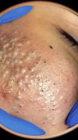 #satisfatório #pimple #fyp #fyyyyyyyyyyyyyyyy #asmr #fy #satisfatorio #espremerespinha #espinhas #viral 