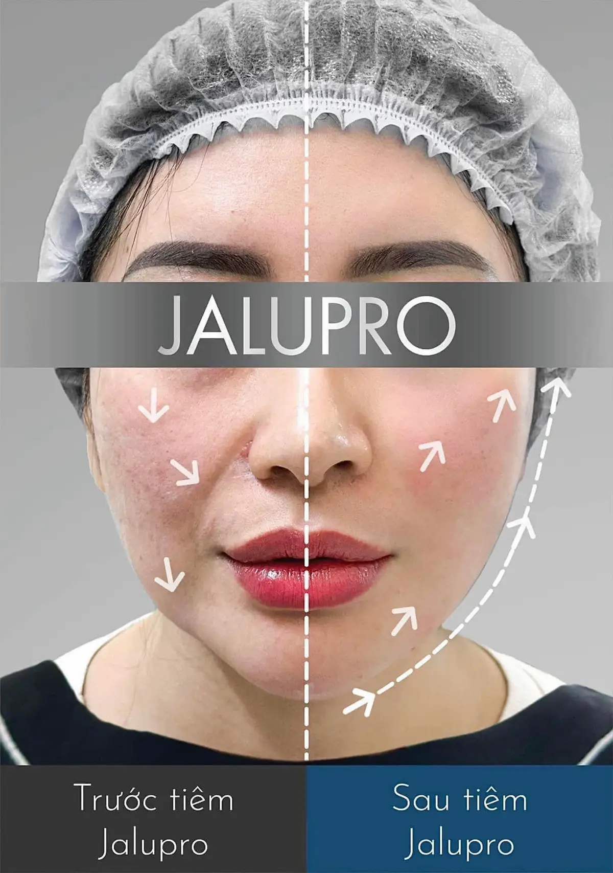 👉🏻 Giải pháp cho các chị đẹp không muốn tiêm Filler . Chỉ muốn được săn chắc gương mặt , nâng vùng cơ chảy sệ bằng phương pháp tiêm vi điểm chỉ 6+1 điểm tiêm  👉🏻 Cam kết không đau , không nghĩ dưỡng 👉🏻 Hiệu quả ngay sau 1-2 tuần , các mô mỡ và vùng da bị chảy sệ được nâng lên rõ rệch  #Tiêm_BAP_Jalupro  #DBeauty