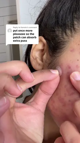 Replying to @itsnotu  Here it is, see you tomorrow😄  #pimplepatch #pimplepatches #pimple #acneskin #acnetreatment #acnefighter #acnepatch #cysticacne #acnepositivity 