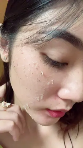 Chấm tàn nhang có sẹo không? #64_vinhlong #fb_suri #sẵn_tại_nhật #peel #chấm_tàn_nhang_tại_nhà 
