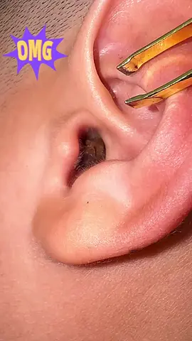 #foryou #earwax #earwaxremoval #earwaxcleaning #pimple #blackhead #earwaxremmoval #earwaxcleaning #pimple #blackhead #fyp #cleaning #foryoupage #funny 