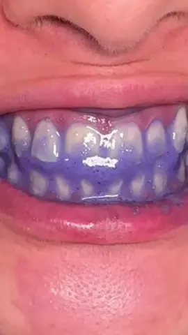 Quick easy fix at home🦷@hismile teeth whitening at home✨ #hismile #teethwhitening #teethwhiteninghack #teethwhiteningathome #purpletoothpaste #whitening #whiteteeth #oralhygiene 