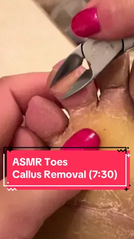 Gone for 2 weeks! I missed you guys 🥰 #callusremoval #podiatrist #parmeseanpalms 