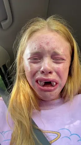 Why Getting Wisdom Teeth Removed Can Get You In TROUBLE! 😳🦷 #wisdomteeth #mouth #dentist 