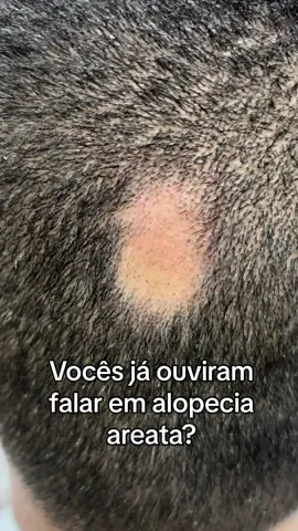 ✨ Já ouviram falar em alopecia areata? 🔎💖  #dermatologia #alopecia #medica #fyp 