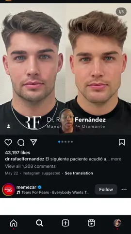 #greenscreen he look like a super hero #plasticsurgery #transformation #men 
