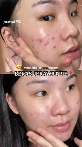 bekas jerawat PIE kok susah hilangnya???? emang susah, beneran PR BGT & harus extra sabar. 🥹👌🏻 cara aku meredakan PIE adalah basic hydrating skincare yg fokus di soothing & calming, dibantu skincare yg ada kandungan Tranexamic Acid itu paling ngaruh di PIE aku. kalo ditanya moisturizer calmingnya apa? aku bakalan rekomendasiin moist acnaway mugwort water gel ini, yg sekaligus bantu ngeredain pas lg ada jerawat meradang. harganya pun masih kantong pelajar friendly! cuma 30ribu-an aja 👌🏻💖 worth to try! #bekasjerawat #PIE #jerawatpie #moisturizer #rekomendasimoisturizer #mugwort #acneskincare 