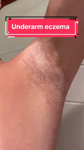 #eczemarashes on the #armpits is soooooo uncomfortable. Whenever I get an #eczemaflareup under my arms it often gets infected & turns into a #fungalinfection. When that happens I find that #antifungal cream like 1% #clotrimazole helps. But more importantly I try to manage this #dryskin by always making sure I dry skin creases well after showering & applying #emollients, layering #ointments when I get #flakeyskin. #eczemawarriors where’s the worst place you get #eczema? #eczemawarrior #eczemaawareness #eczemawarrior #eczemahealing  