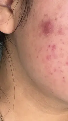 😭#acne #acnegirl #oilyskin #foryou #acneskin 